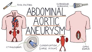 Understanding Abdominal Aortic Aneurysms [upl. by Initsed]