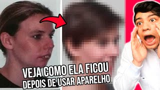 10 Pessoas que FICARAM IRRECONHECÍVEIS depois de tirar o Aparelho [upl. by Bang102]