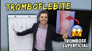 TROMBOFLEBITE  TROMBOSE SUPERFICIAL  Sinais sintomas e tratamentos [upl. by Annehs]