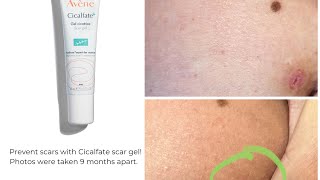 Avène Cicalfate Scar gel How to prevent scars treat them amp real before amp after photos included [upl. by Yule]