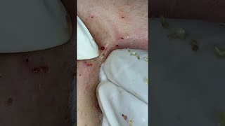 Big Cystic Acne Blackheads Extraction Blackheads amp Milia Whiteheads Removal Pimple Popping shorts [upl. by Malik]