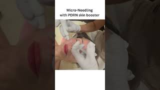 Micro Needling with PDRN skin booster [upl. by Akcirahs]