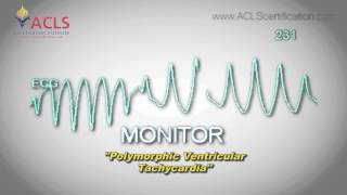 Polymorphic Ventricular Tachycardia PolyVTach by ACLS Certification Institute [upl. by Herrmann481]