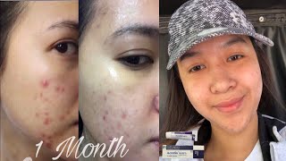 How to use Retinol for Acne  Vitamin A cream  Acretin 05 [upl. by Maribeth]