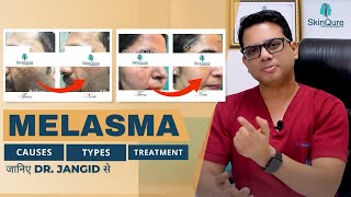 All About Melasma  Causes Types and Treatment options  जानिए Dr Jangid से हिंदी में  SkinQure [upl. by Auhsuj]