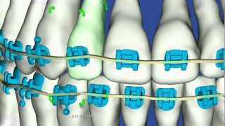 5 Easy steps Seating Ortho Bands [upl. by Swayder]