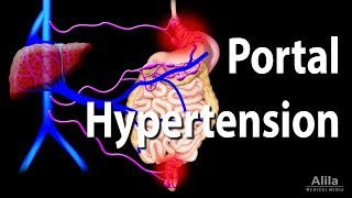 Portal Hypertension Animation [upl. by Alburg488]