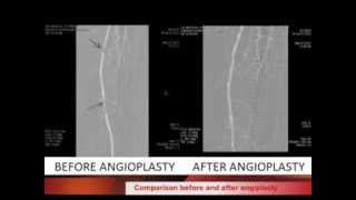 ANGIODROID  CO2 ANGIOGRAPHY [upl. by Esinyt]