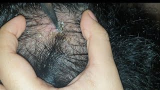 best patch of dandruff scab found so far  satisfying  watch till end  scab pick using knife asmr [upl. by Fabriane]