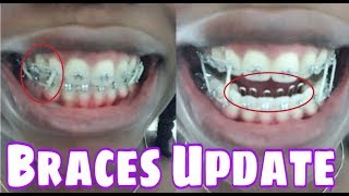 BRACES UPDATE Tongue Crib Ligature Tie Overbite Closed Spacing [upl. by Tobye]