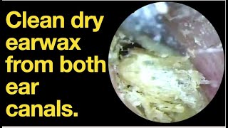 Clean dry earwax from both ear canals ear wax removal  ear cleaning  ASMR  relaxation  relax [upl. by Nnoj739]