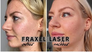 FRAXEL LASER BEHANDLUNG vorher nachher BilderVideos nach 2 Monaten [upl. by Bailie]