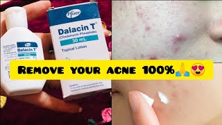 100 Remove Acne amp pimple🔥  Guaranteed results self tested ✨  Dalacin T lotion honest review❤️ [upl. by Eisenberg471]