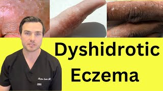 What is Dyshidrotic hand Eczema Causes and treatment [upl. by Nikolas]