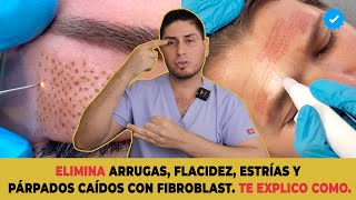 Levantamiento de párpados SIN CIRUGIA  Fibroblast  DOCTOR LEMUS [upl. by Hanoy652]