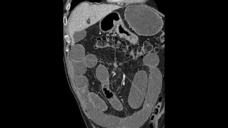 Twist  torsion of the mesentery  WHIRLPOOL SIGN  small bowel obstruction [upl. by Francoise]