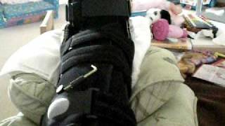 ACHILLES TENDON RUPTURE Update 1 [upl. by Fotzsyzrk714]