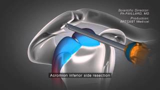 Shoulder Arthroscopy  Acromioplasty [upl. by Lambrecht688]