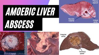 Amoebic liver abscess  Morphology [upl. by Notlrac]