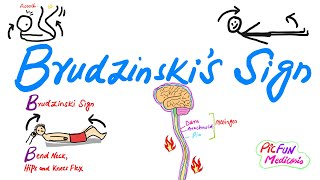 Brudzinskis SignSigns of MeningitisHow to perform SOMI [upl. by Karlik174]