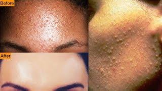 Acne Understanding the Types of Acne and Treatment Options [upl. by Kalbli]