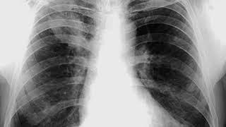 Case 0107 Bronchogenic Carcinoma right upper lobe with metastasis [upl. by Donela]