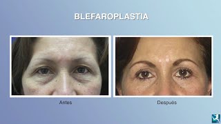 ¿Cómo quedan los ojos después de una blefaroplastia [upl. by Llibyc445]