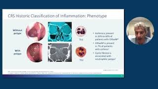 Rhinosinusitis With Nasal Polyps From Pathophysiology to Management [upl. by Harvison]