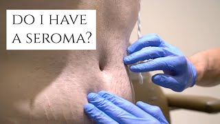 What is a Seroma  Fluid Build Up After Surgery  Symptoms and Treatment  Dr Daniel Barrett [upl. by Pallaten676]