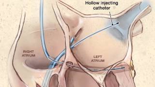 Pulmonary Vein Radiofrequency Catheter Ablation Therapy for Atrial Fibrillation [upl. by Norri133]