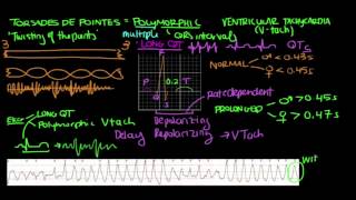 Polymorphic Ventricular Tachycardia PolyVTach by ACLS Certification Institute [upl. by Aicaca]