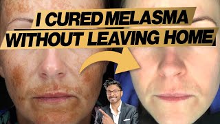 Melasma Treatment At Home Expert Doctors 3 Easy Steps  before and after [upl. by Fronnia598]