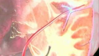 Trapping blood clots to treat stroke [upl. by Timmi]