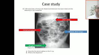 Case 83 necrotising enterocolitis NEC Bell criteria pneumatosis intestinalis pneumoperitoneum [upl. by Darya77]