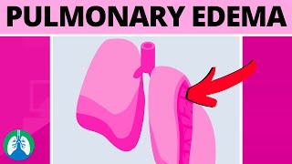 Pulmonary Edema Medical Definition  Quick Explainer Video [upl. by Gainer699]