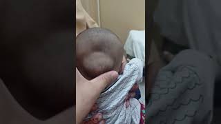 Encephalocele newborncare newbornarrival baby [upl. by Pufahl]