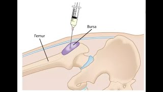 Greater Trochanteric Bursa Injection [upl. by Anatnas]