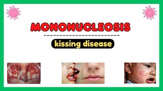 Mononucleosis infection epstein barr virus pathophysiology symptoms diagnosis treatment [upl. by Weiler]