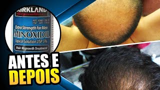 O Minoxidil Pode Causar Impotência Sexual shorts [upl. by Bordiuk]