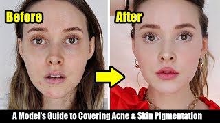 How I Cover My Acne Acne Scars amp Skin Pigmentation  A Models Tips Easy NonCakey [upl. by Teague]