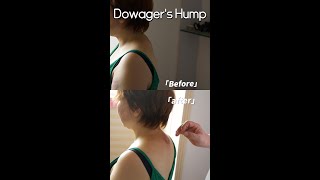 Fix Dowagers Hump via Acupuncture [upl. by Sinnaoi]