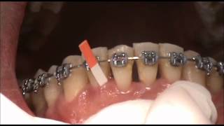 Gingival crevicular fluid volume evaluation in patients with controleed periodontal disease [upl. by Sadinoel777]