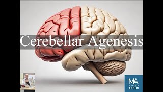 Cerebellar Agenesis [upl. by Mcmillan161]