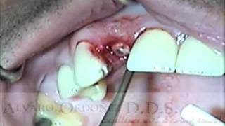 Atraumatic Extraction Socket preservation and temporization  Alvaro Ordoñez DDS [upl. by Allard]