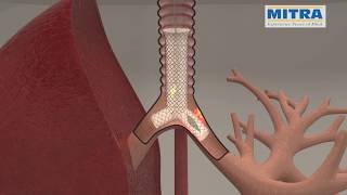 Tracheobronchial quotYquot stent MITRA OTTOMED ENDOSCOPY Interventional Pulmonology [upl. by Buford]