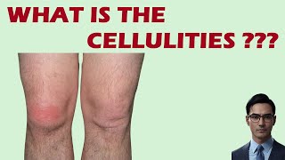 Understanding Cellulitis Causes Symptoms and Treatment  Comprehensive Guide 2023 [upl. by Atsylac]