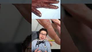 What is dyshidrotic eczema eczema rash doctor [upl. by Assiluj]