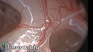 Otosclerosis stapes fixation and visualization of sinus tympani and red blood cells [upl. by Anileme]