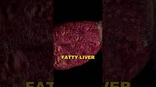 Understanding NAFLD NonAlcoholic Fatty Liver Disease Explained [upl. by Raimondo263]