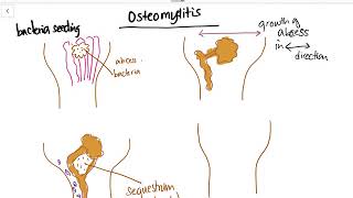 Osteomyelitis  Sequestrum Involucrum Draining sinus Explained [upl. by Lehrer48]